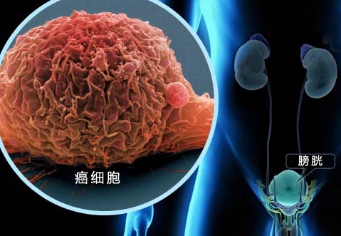 改善生存狀況 老年膀胱癌也可考慮輔助化療