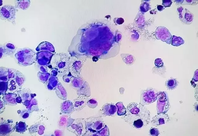 腫瘤專(zhuān)家揭秘：細(xì)胞治療不是越“多”越好